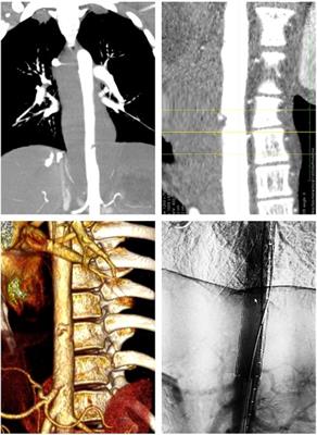 Case report: Endovascular stent-graft repair of aortic penetrating trauma, literature review, and case report